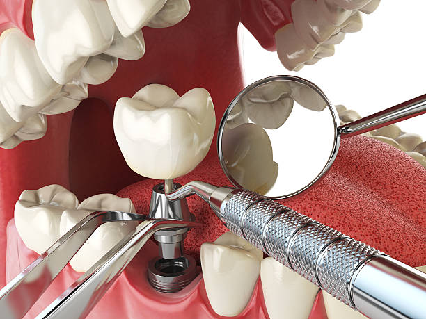 Best Emergency Tooth Extraction in Honeoye Falls, NY